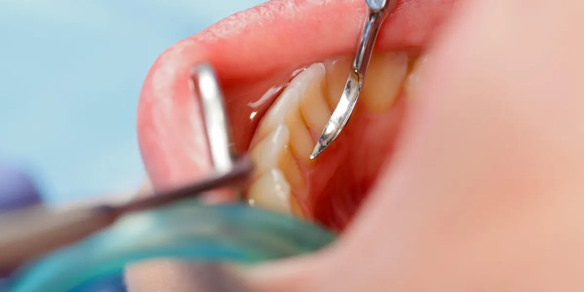 close up of a dental calculus removing close up of a dental calculus removing