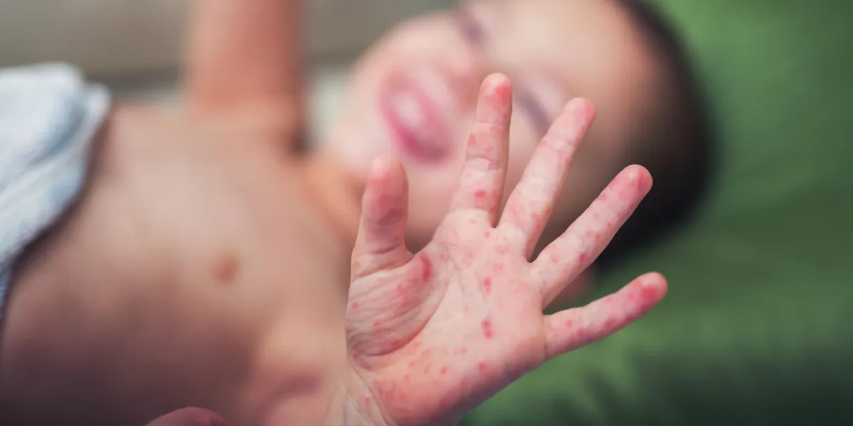 boy with symptoms hand, foot and mouth disease boy with symptoms hand, foot and mouth disease