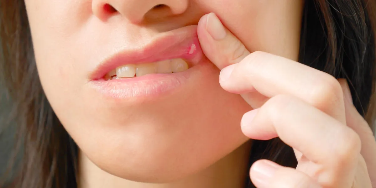 canker sore on woman upper lip canker sore on woman upper lip