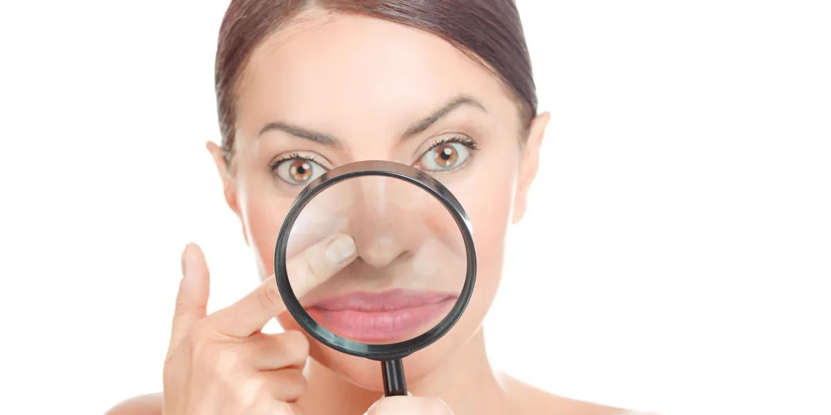 acne blackheads on woman's nose showed in a magnifying glass, facial scar, skin problem, beauty concept girl holding magnifier to show bumpy skin, clog pores, which appears to be clean focus on nose