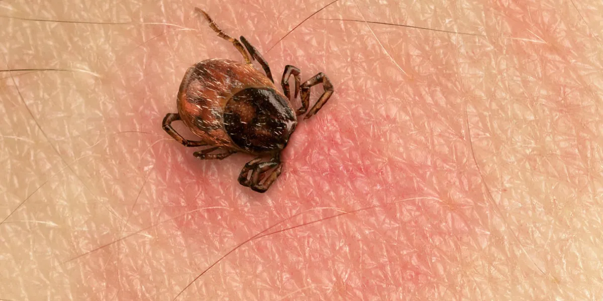 tick with its head sticking in human skin, red blotches indicate an infection tick with its head sticking in human skin, red blotches indicate an infection