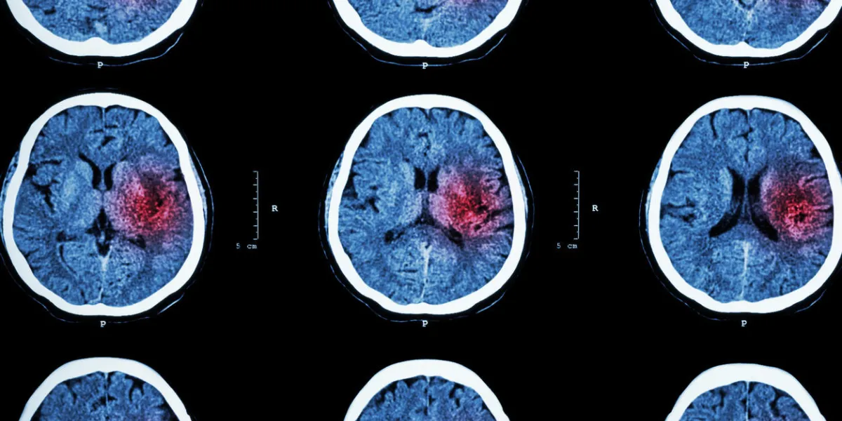ct scan of brain with red area ( imaging for hemorrhagic stroke or ischemic stroke ( infarction ) concept )