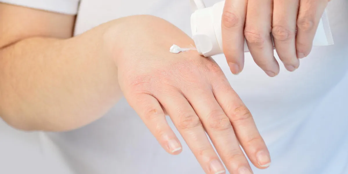 cropped image of a young woman putting moisturizer onto her hand with very dry skin and deep cracks with cream