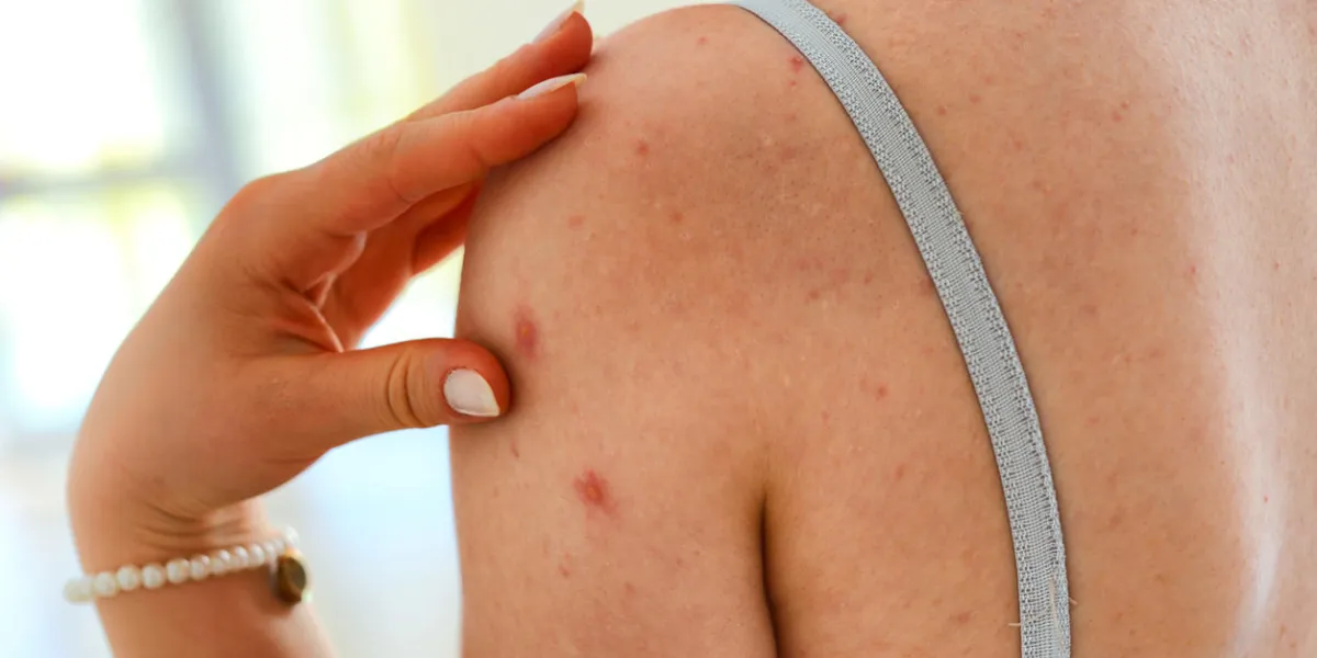 eczema
