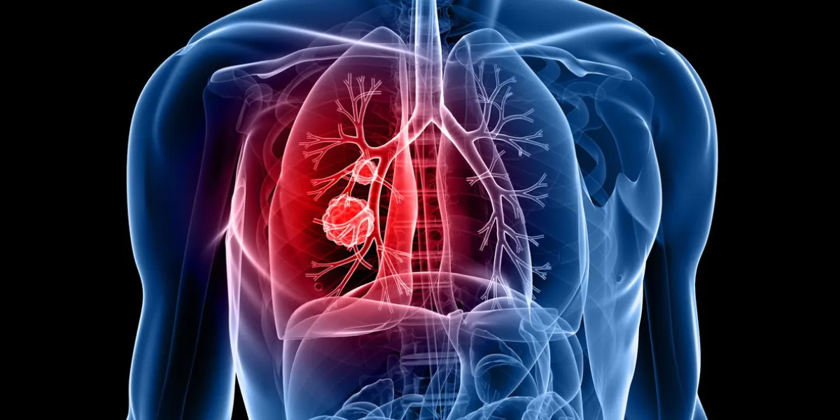 lung cancer lung cancer