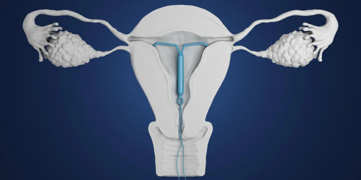 3d rendered illustration of an intra-uterine device 3d rendered illustration of an intra-uterine device
