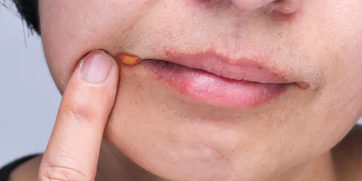 angular cheilitis is a type of common inflammation of the lips angular cheilitis is a type of common inflammation of the lips