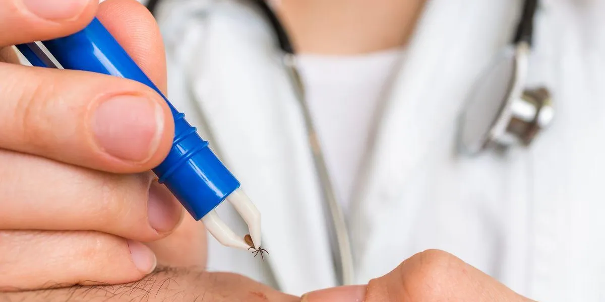 female doctor removing a tick with tweezers from hand of patient encephalitis, borreliosis and lyme disease