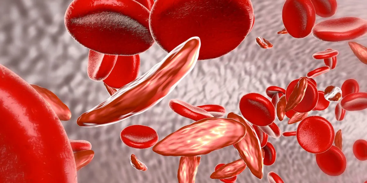 sickle cell anemia, 3d illustration showing blood vessel with normal and deformated crescent-like red blood cells