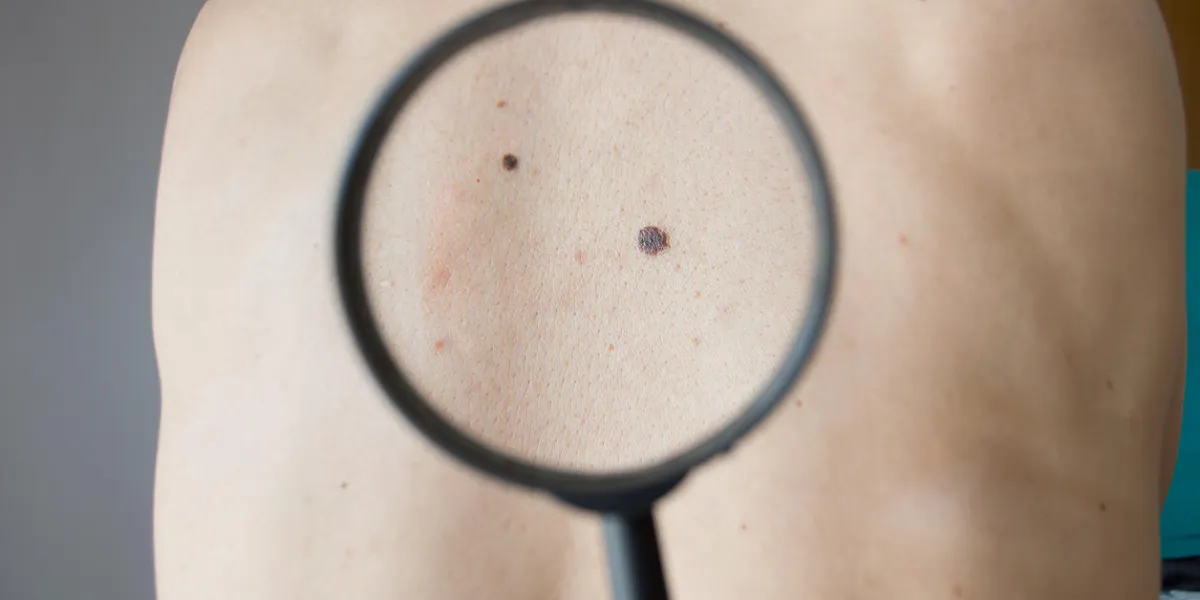 checking melanoma on a back of a man with magnifying glass