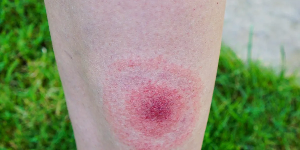 lyme disease, borreliosis or borrelia, typical lyme rash, spot a person, leg bitten by a deer tick selective focus lyme disease, borreliosis or borrelia, typical lyme rash, spot a person, leg bitten by a deer tick selective focus