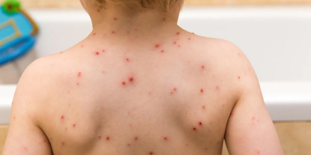 two year old boy with chicken pox