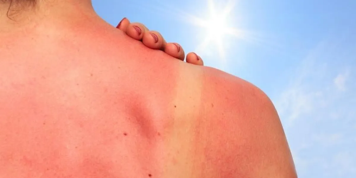 sonnenbrand sonnenbrand