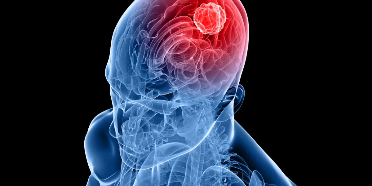 a 3-d image of a human skull and brain depicting cancer a 3-d image of a human skull and brain depicting cancer