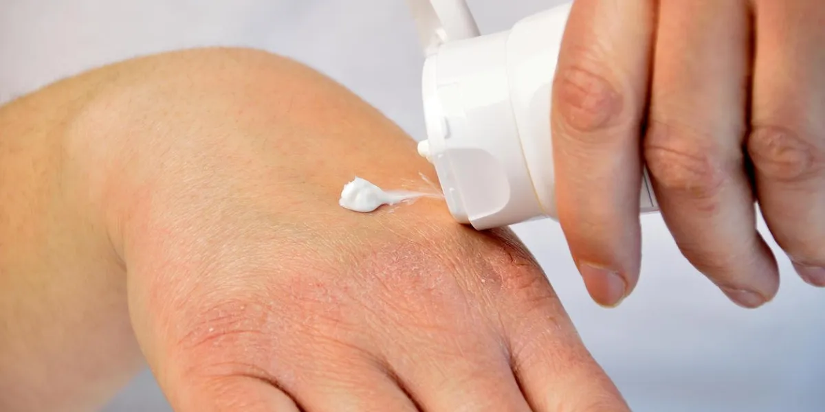 cropped image of a young woman putting moisturizer onto her hand with very dry skin and deep cracks with cream