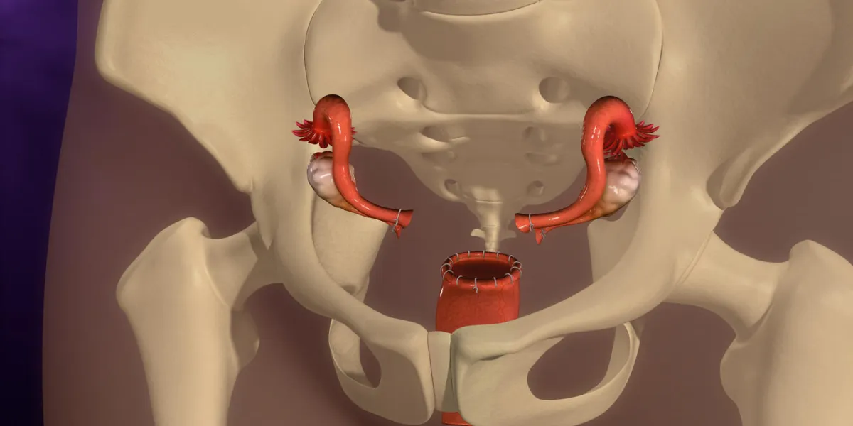 une hystérectomie est une opération pour enlever l'utérus d'une femme une femme peut avoir une hystérectomie pour différentes raisons, y compris des fibromes utérins qui causent de la douleur, des saignements ou d'autres problèmes une hystérectomie est une opération pour enlever l'utérus d'une femme une femme peut avoir une hystérectomie pour différentes raisons, y compris des fibromes utérins qui causent de la douleur, des saignements ou d'autres problèmes