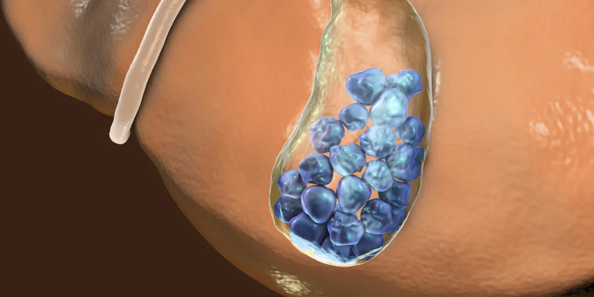 gallstones, 3d illustration showing bottom view of liver and gallbladder with stones gallstones, 3d illustration showing bottom view of liver and gallbladder with stones