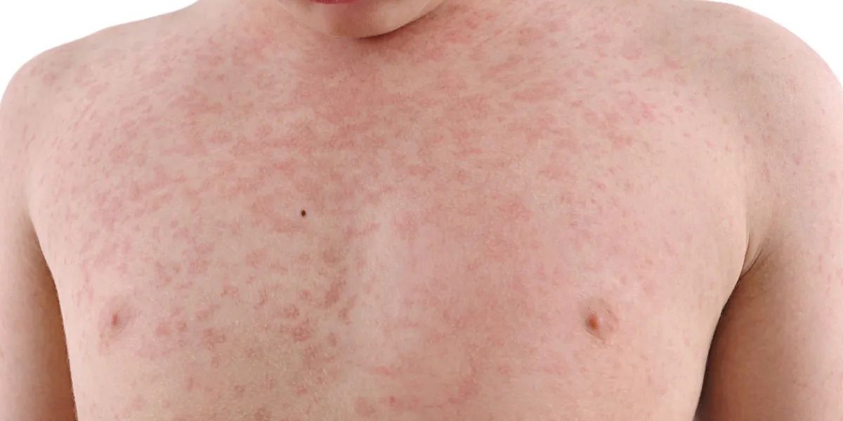 child's body suffering urticaria