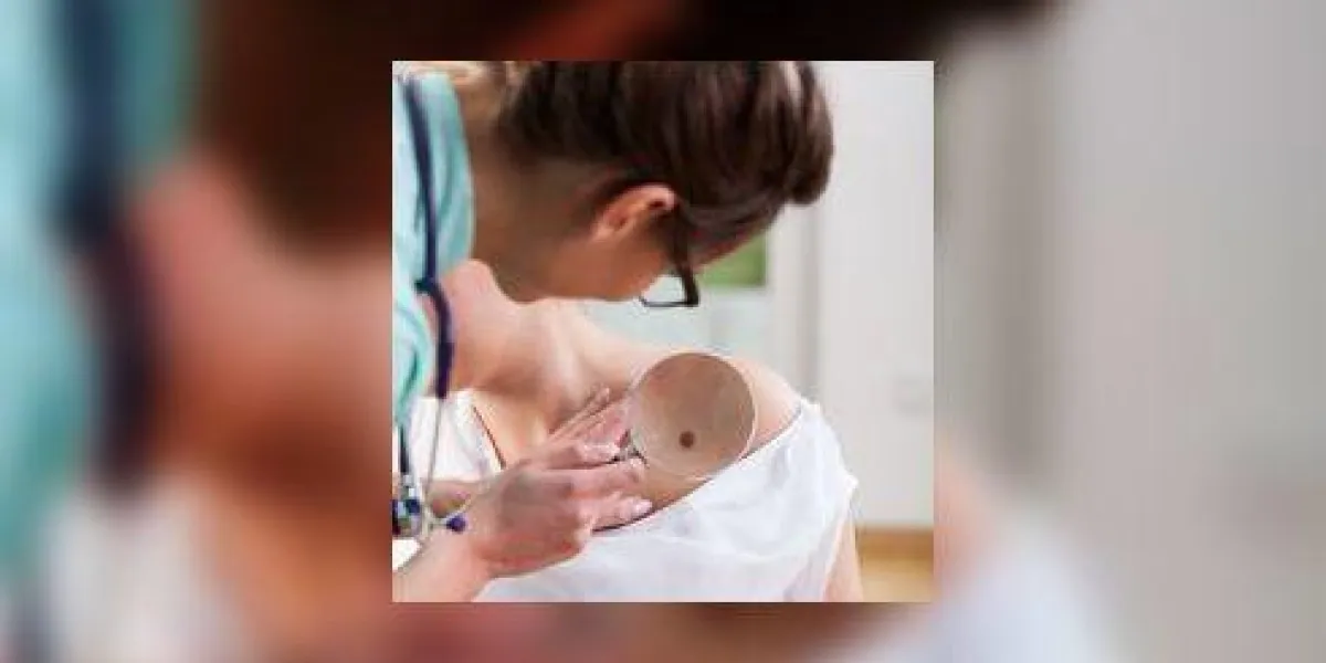 dermatologue examinant la taupe sur le bras de la femme, verticale