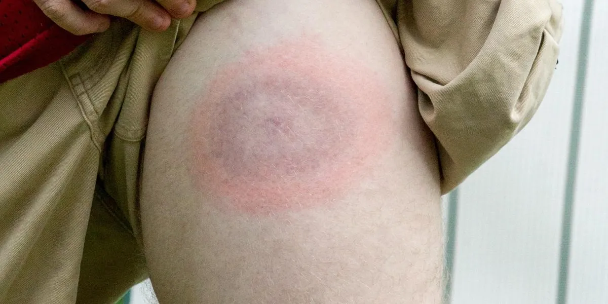 lyme disease bullseye on young mans leg lyme disease bullseye on young mans leg