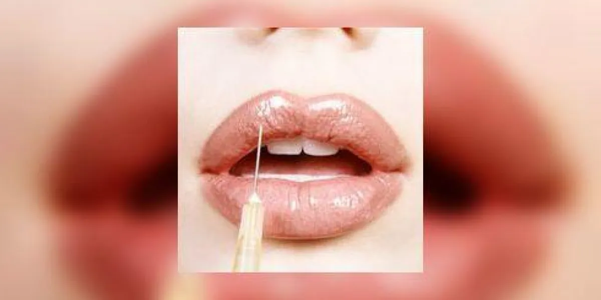 gros plan des lèvres d'une femme recevant une chirurgie esthétique d'une seringue gros plan des lèvres d'une femme recevant une chirurgie esthétique d'une seringue