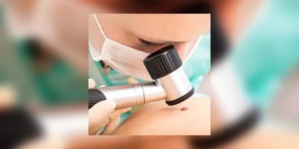 un dermatologue examine le marqueur de naissance d'un patient avec un dermatoscope