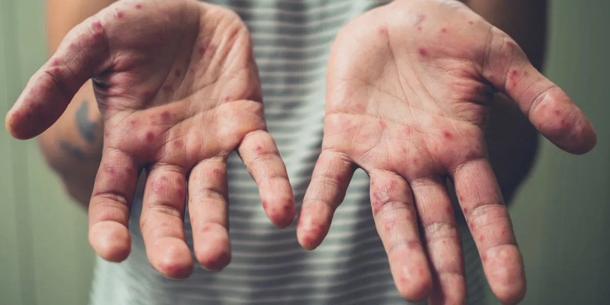 a young man is showing his hands with spots and rash from hand foot and mouth disease