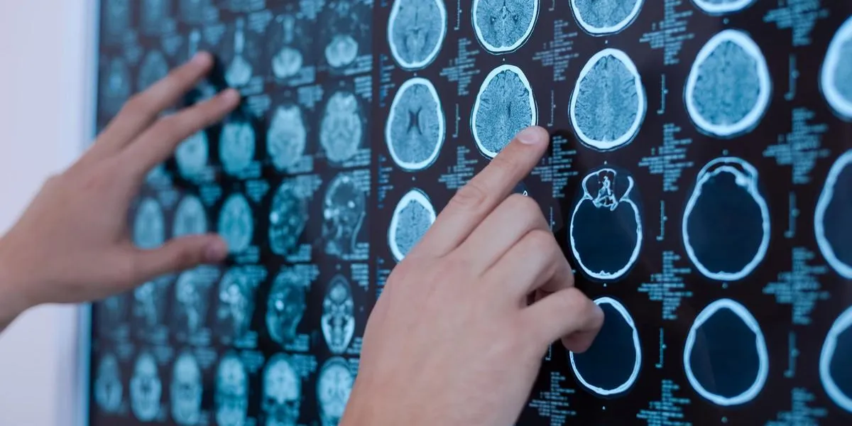 professional medicine close up of x ray images of human brain being put on the whiteboard by a nice professional oncologist