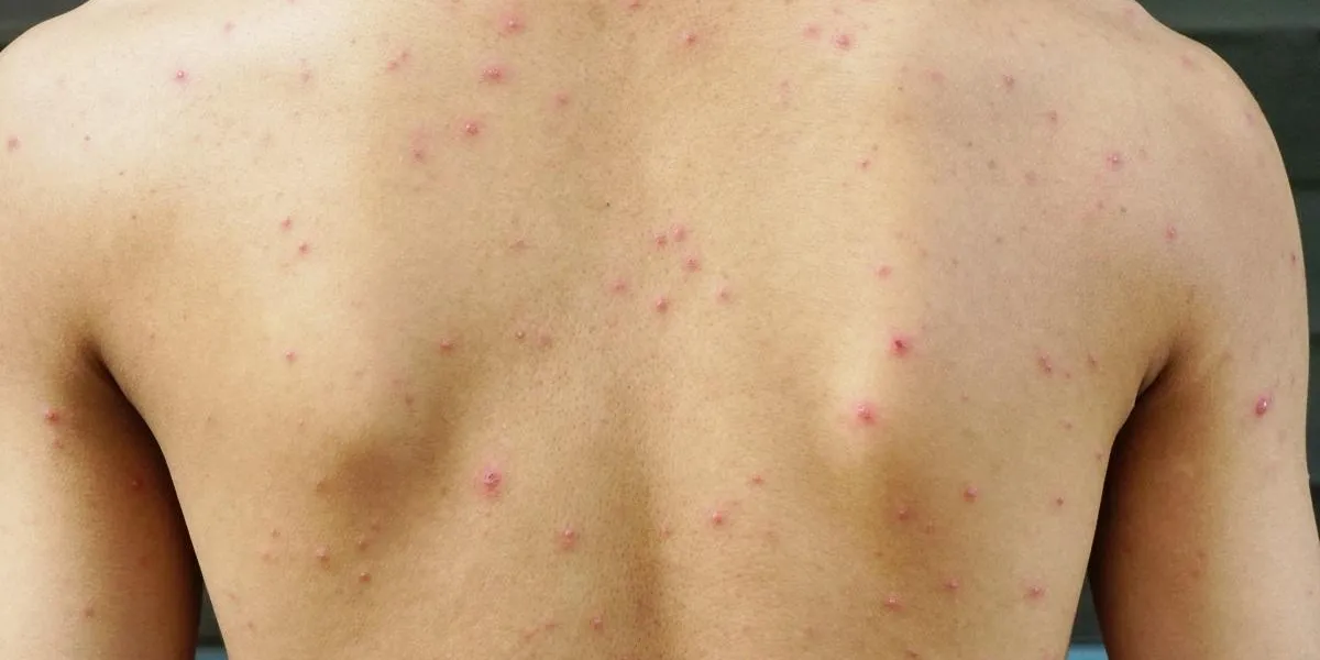 back side body of a man have spotted, red pimple and bubble rash from chicken pox or varicella zoster virus