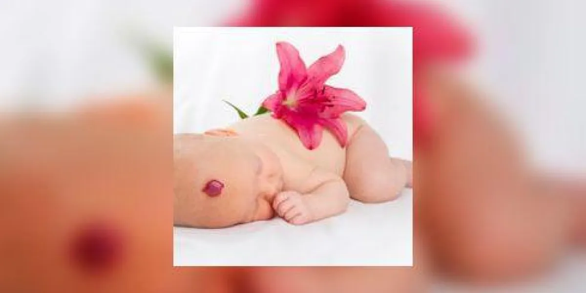 petit bébé avec hémangiome petit bébé avec hémangiome
