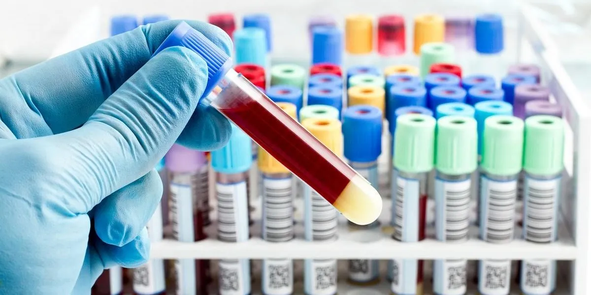 hand of a lab technician holding blood tube test and background a rack of color tubes with blood samples other patients   laboratory technician holding a blood tube test