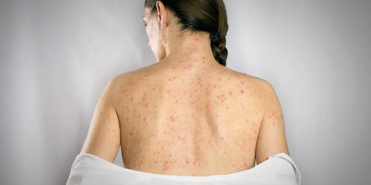 treatment chickenpox viral infection concept girls back skin rashes treatment chickenpox viral infection concept girls back skin rashes