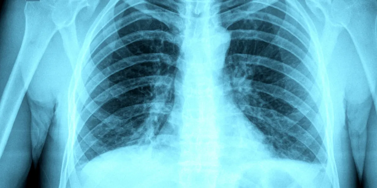 chest x-ray image