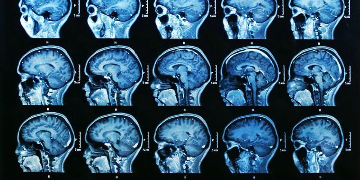 irm du cerveau irm du cerveau
