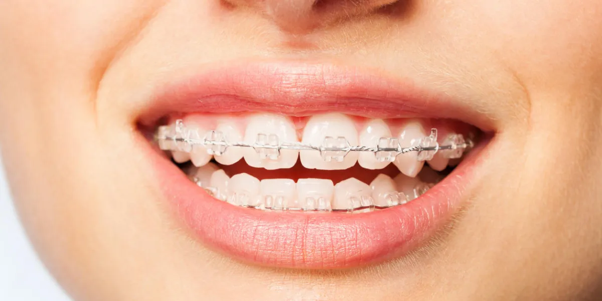close-up picture of healthy smile woman with clear brackets close-up picture of healthy smile woman with clear brackets