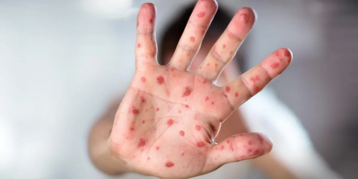 hfmd - hand foot and mouth disease - viral diseases with hand infected
