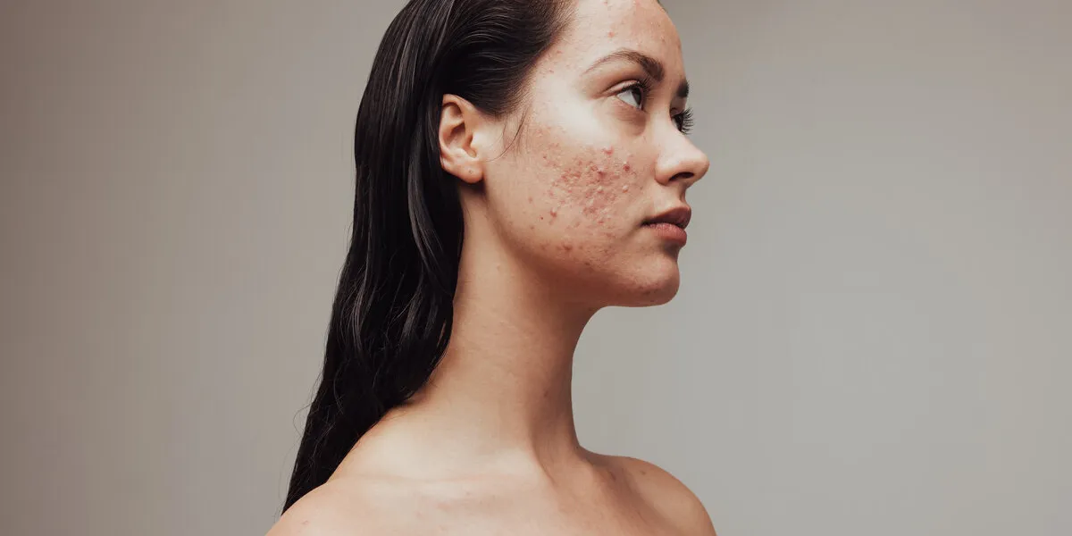 side view portrait of woman with acne close up of sad woman having skin problem