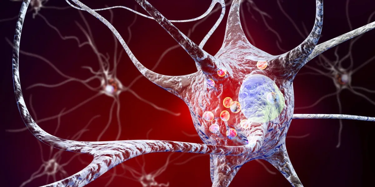 parkinson's disease 3d illustration showing neurons containing lewy bodies small red spheres which are deposits of proteins accumulated in brain cells that cause their progressive degeneration parkinson's disease 3d illustration showing neurons containing lewy bodies small red spheres which are deposits of proteins accumulated in brain cells that cause their progressive degeneration