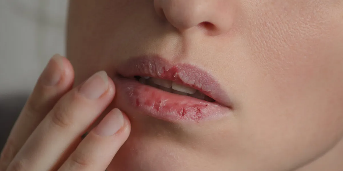 dermatillomania skin picking woman has bad habit to pick her lips harmful addiction based on anxiety stress and dry lips excoriation disorder sick cracked damaged tissue