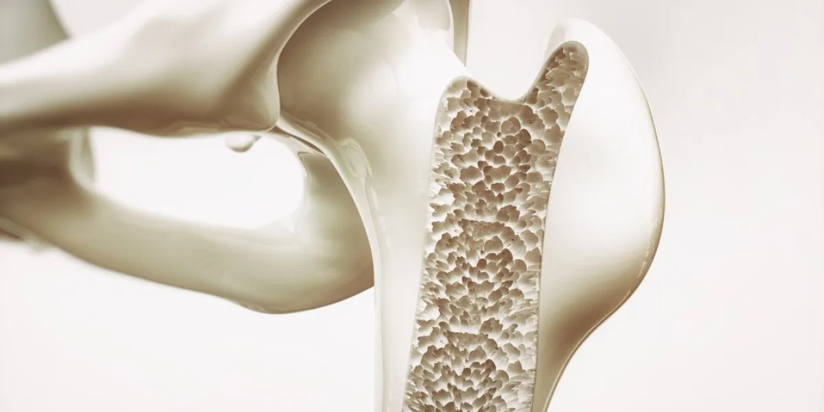 osteoporosis stage 4 of 4 - upper limb bone - 3d rendering osteoporosis stage 4 of 4 - upper limb bone - 3d rendering