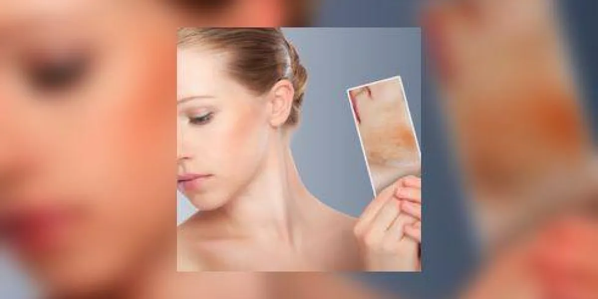 peau de concept peau de beauté jeune femme avec des rougeurs, des problèmes de peau, l'acné, des éruptions cutanées, des brûlures sur un fond gris peau de concept peau de beauté jeune femme avec des rougeurs, des problèmes de peau, l'acné, des éruptions cutanées, des brûlures sur un fond gris