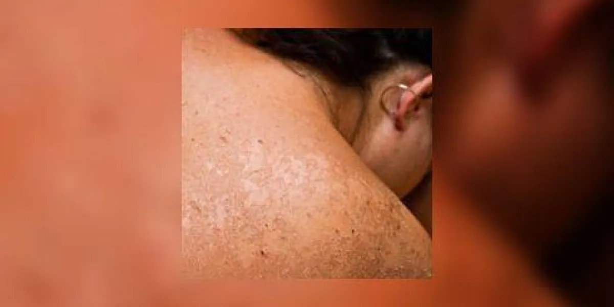 peau brûlée par le soleil peau brûlée par le soleil
